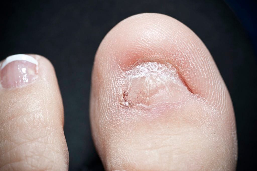 My Toenail Came Off…Now What?