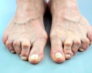 Hammertoe