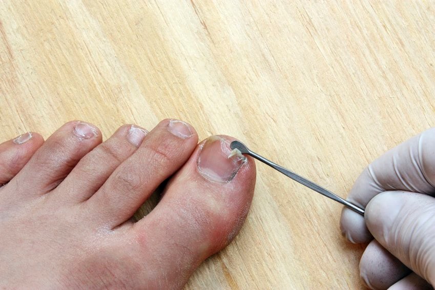 Toenail Cracking Down the Middle? Here’s Why