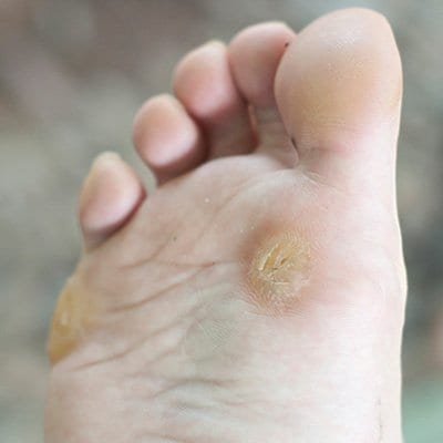 Plantar Warts